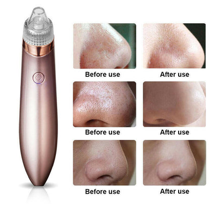 ClearPore™ Professional Blackhead Vacuum – 3-Level Suction Pore Cleaner & Acne Remover